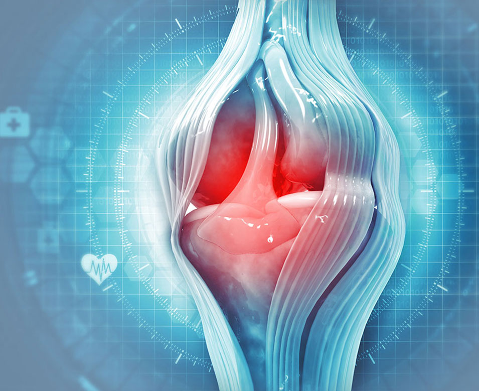 Diagram of knee pain before Advanced Joint Pain Relief